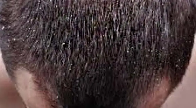 Top 7 Dandruff Remedies For Monsoon