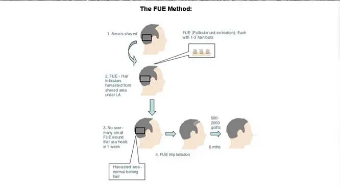FUE & FUT – The 2 Most Effective Hair Transplant Procedures!