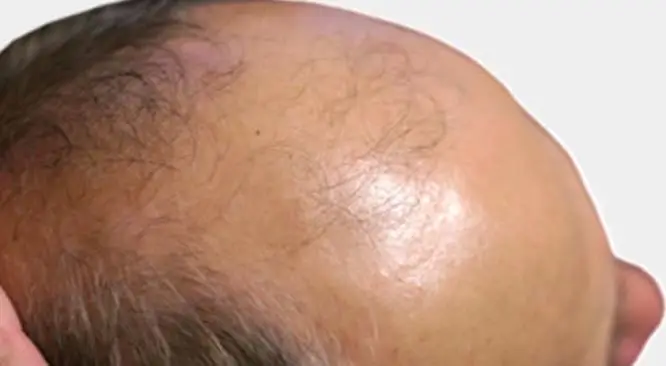 How Stress & Depression Connected With Hair Loss?