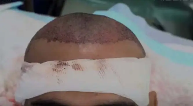 FUE HAIR TRANSPLANT