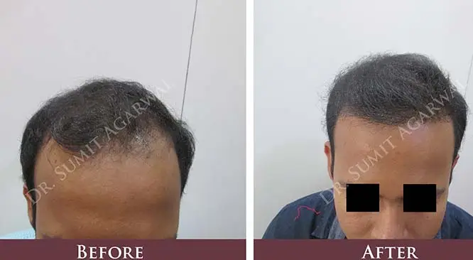 FAQS That Will Change The Way You See Hair Transplants