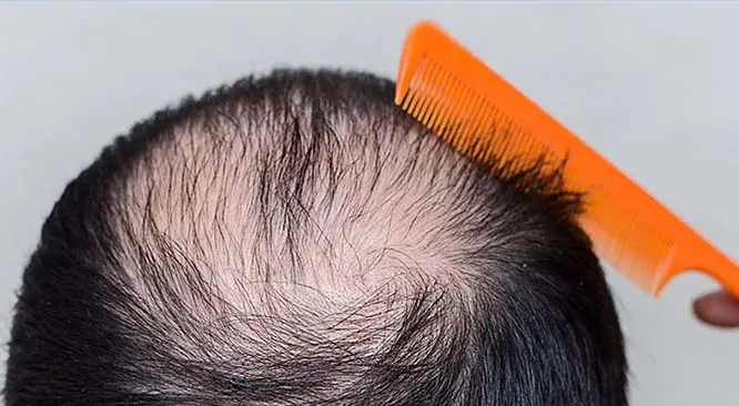 How Much Does A Hair Transplant Cost