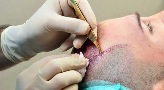 How painful is hair transplant?