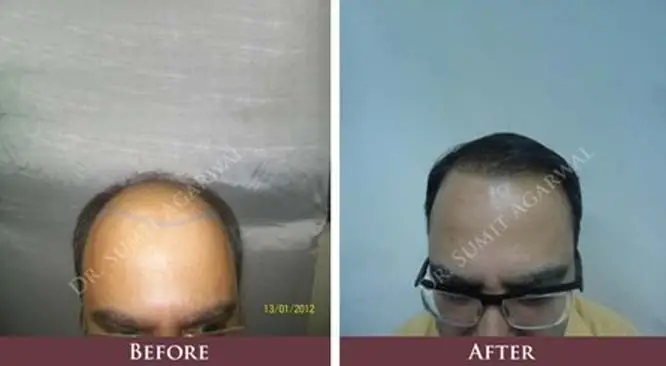 Precautions To Take Before Hair Transplant Surgery