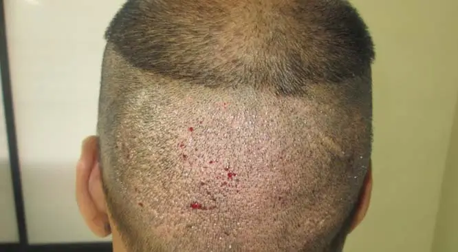 FUE for Grade 5 Male Pattern Baldness