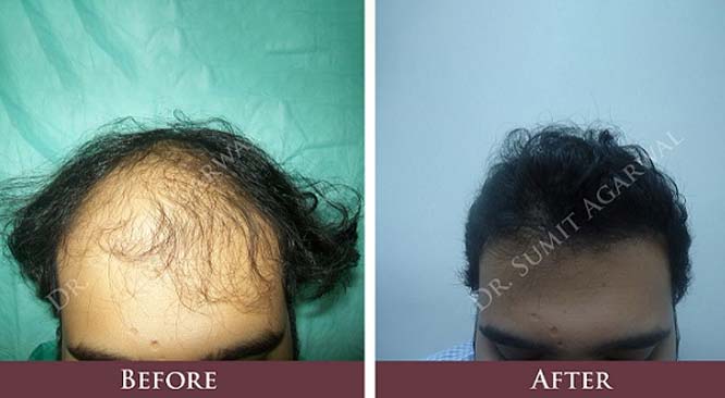 FUE Direct Hair Transplant  DRHC Dubai Hair Transplant Clinic