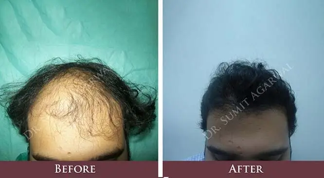Is Hair Transplant An Ideal Choice For You?