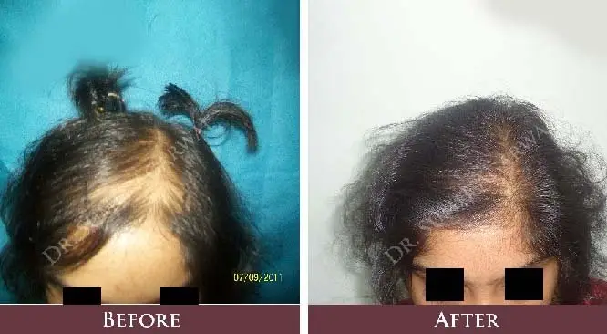 Exclusive Questions About Hair Transplant