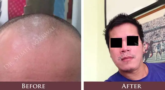 Tired Of Baldness? Try Hair Transplant in India