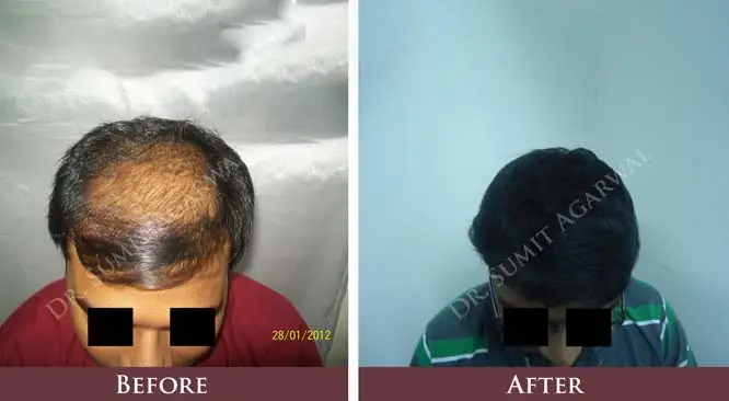No Need to Wear a Cap to Hide Your Baldness Anymore!