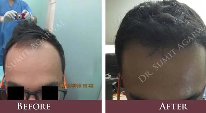 Avoid Hair Loss with Amazing Hairstyling Tips