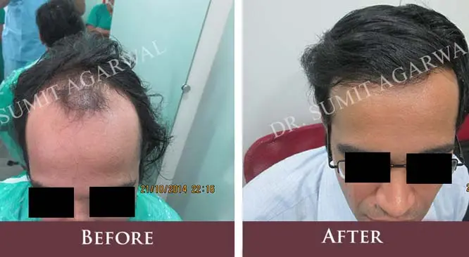Top 7 Myths About Hair Transplant In India