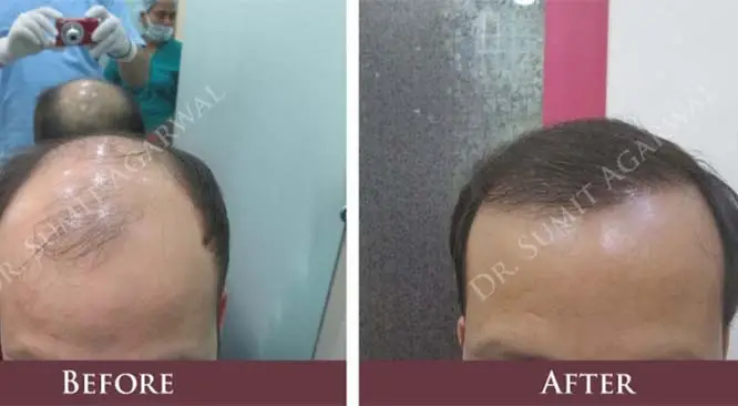 Top 8 Aftercare Tips For Hair Transplant