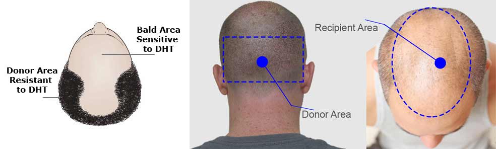 Are the results of hair Transplant Permanent?