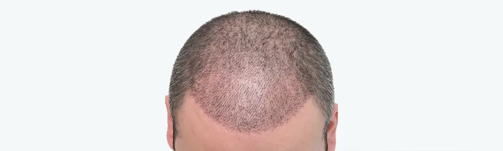 Hair Transplant After Care