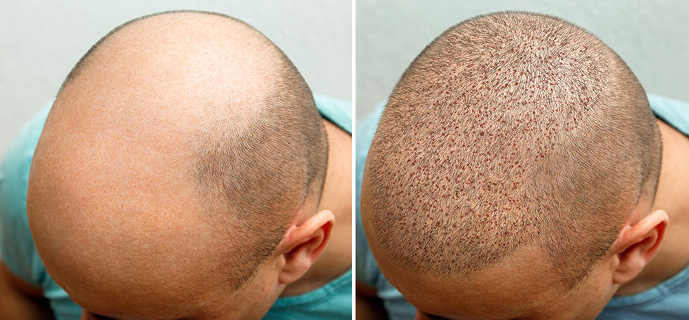 Hair Transplant vs Other Hair Restoration Methods: Pros and Cons