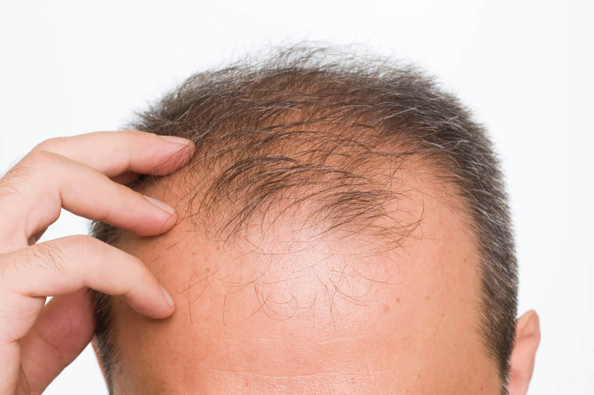 Top 5 Treatments for Male Pattern Baldness in 2022