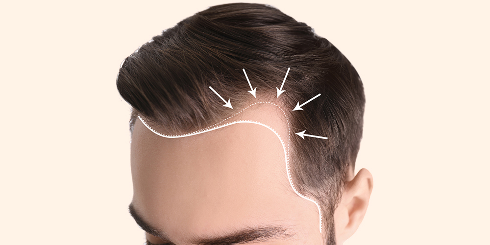 A Guide to High Density Hair Transplantation  Hair Transplant Specialists   Treatment Rooms London