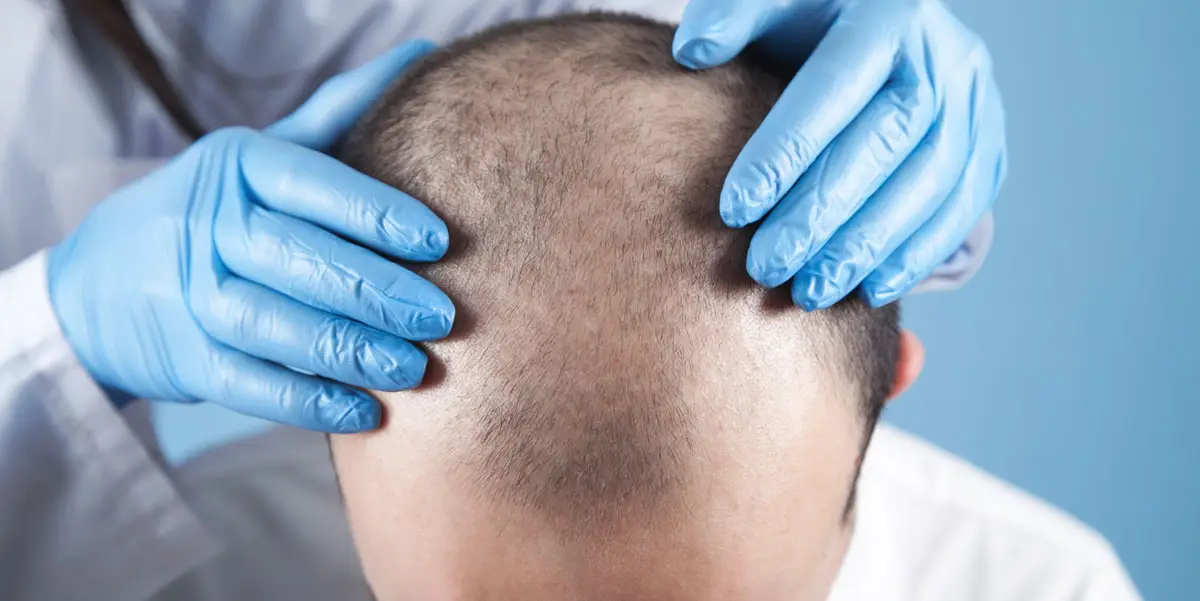 Is Hair Transplant Safe