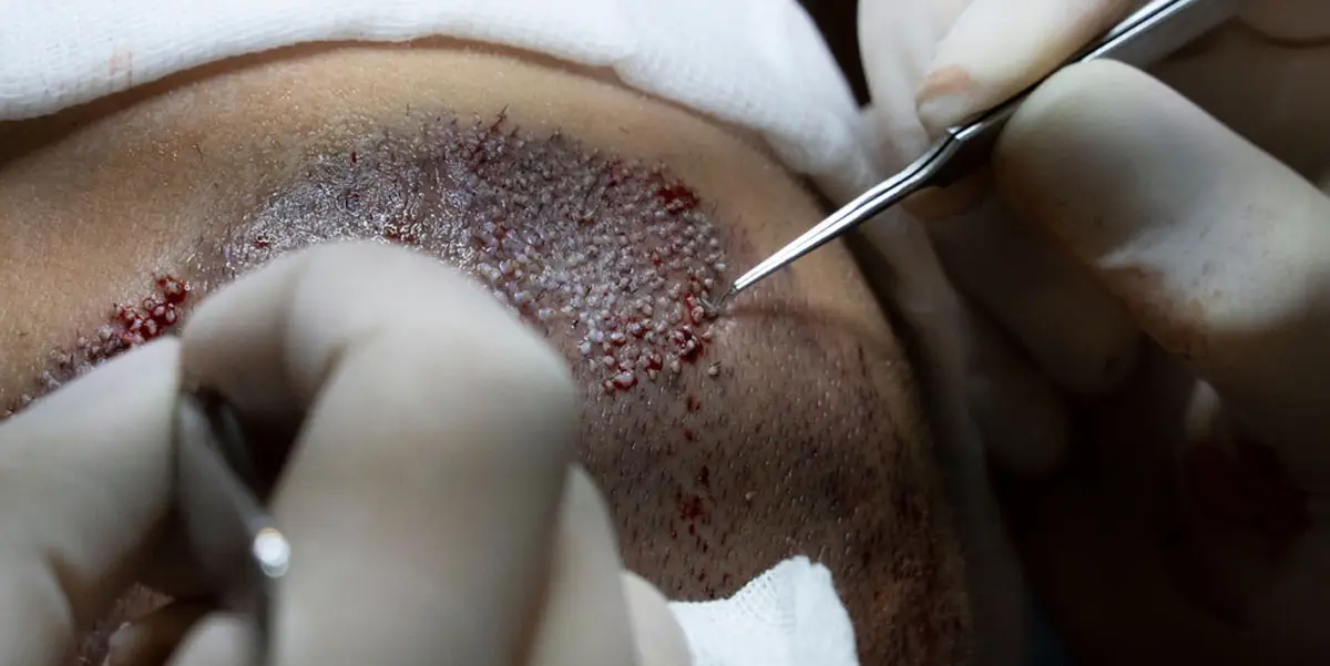 Is Hair Transplant Safe