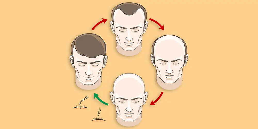 Hair Transplant Before and After Transformations 2023