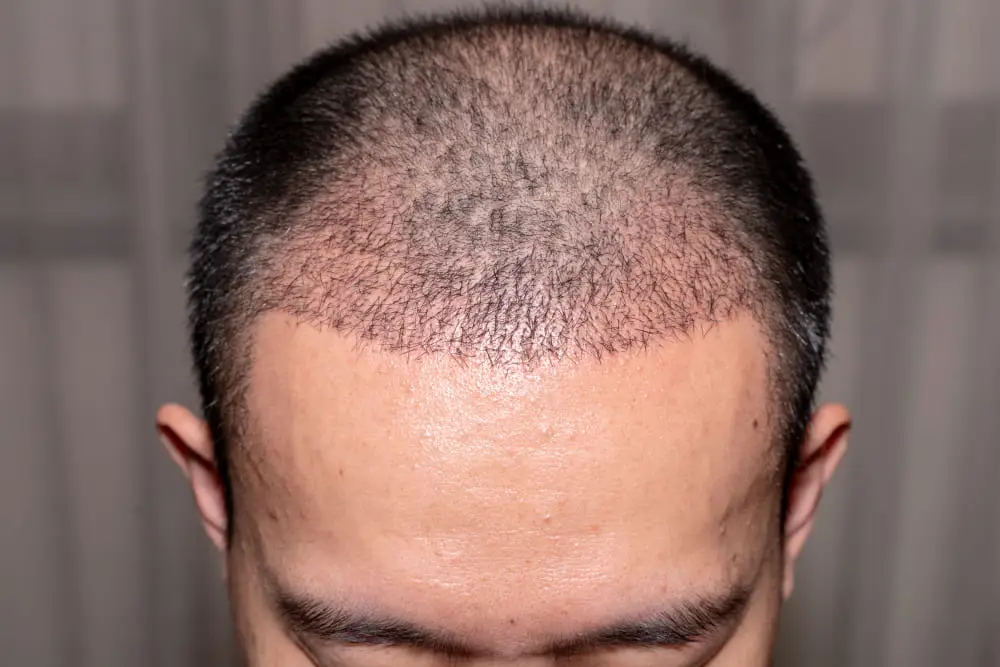 Different FUE Hair Transplant Techniques