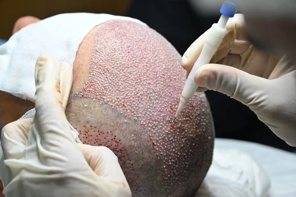 Hair Transplant Transformations in Hair Loss