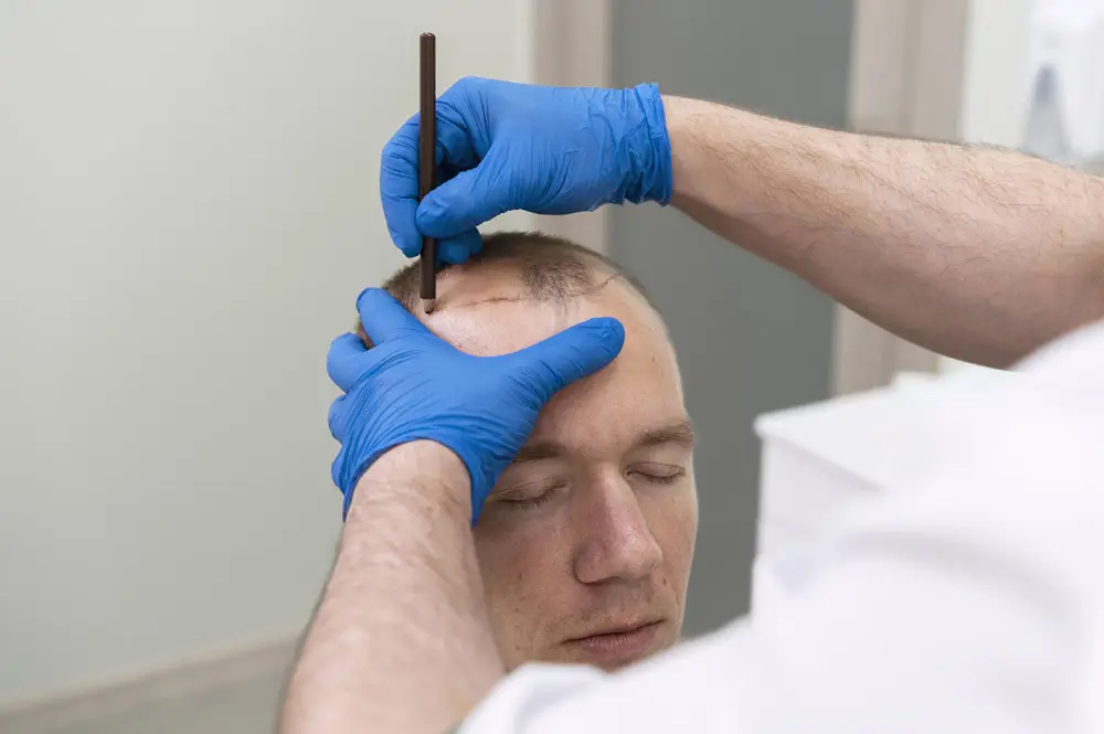 FUE Hair Transplant Procedure