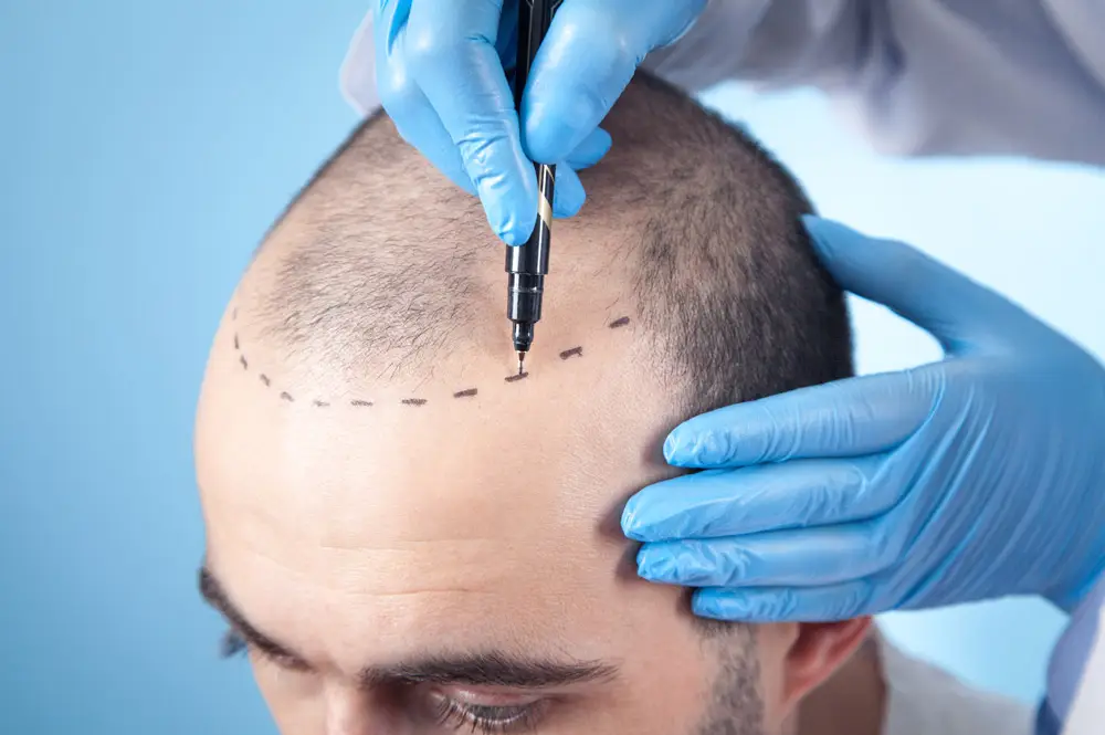 Frontal Hairline Design: Stepwise Approach