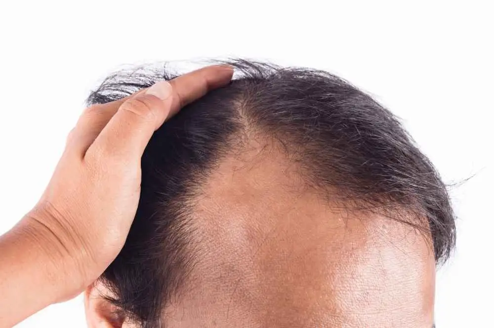 Hair Transplant in Mumbai