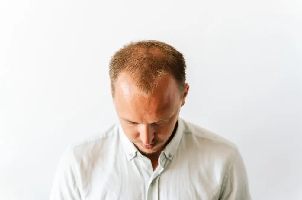 Do You Have to Take Finast-eride After a Hair Transplant?