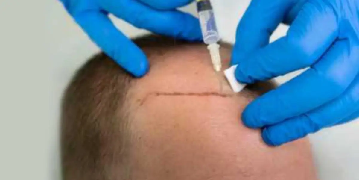 Is a Hair Transplant Painful?