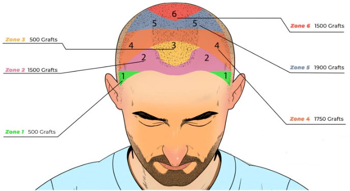 How many hair transplant grafts are actually needed by an individual