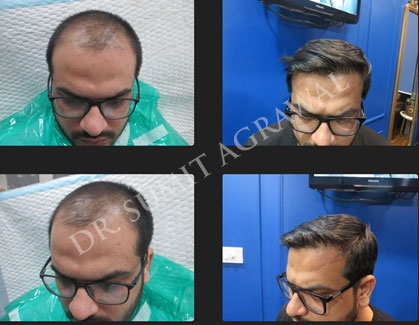 Successfully Transplanted 2,160 Hair Grafts and 4,514 Hair