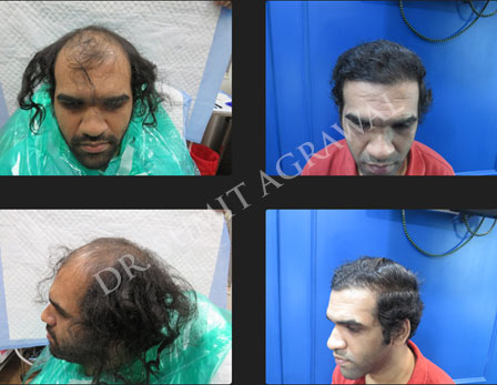 Successfully Transplanted 3,138 Hair Grafts and 5,667 Hair Follicles