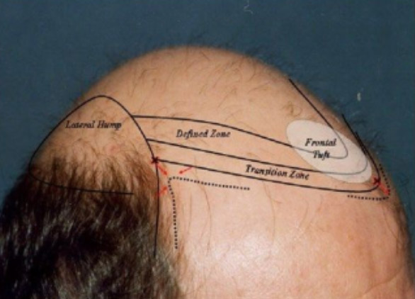 Hairline design