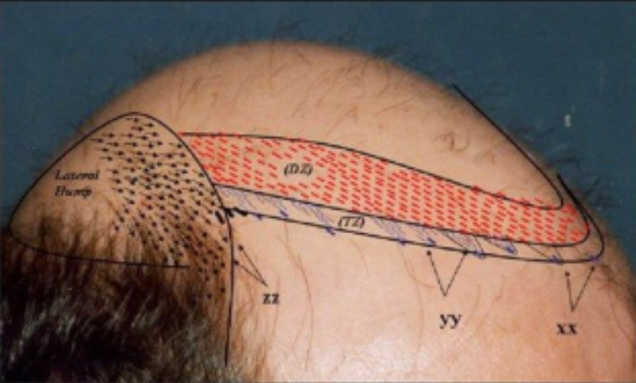 Hairline design