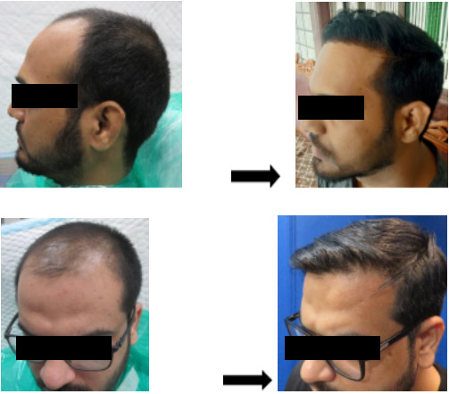 Artistic Hairline Design Before After Results