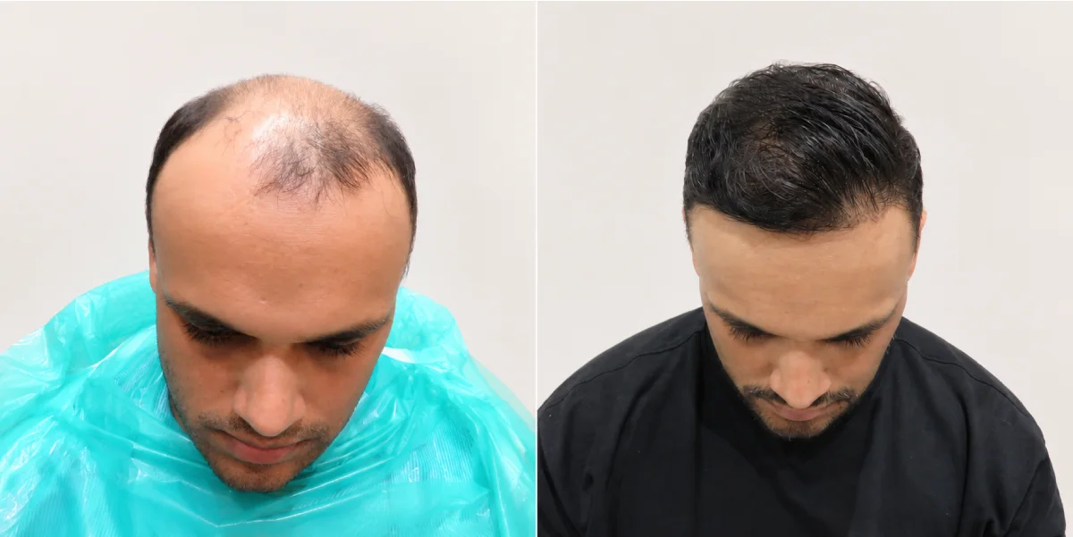 Advanced Sapphire FUE Hair Transplant: 4,500 Grafts for Grade 5 Hair Loss – Real Patient Case Study