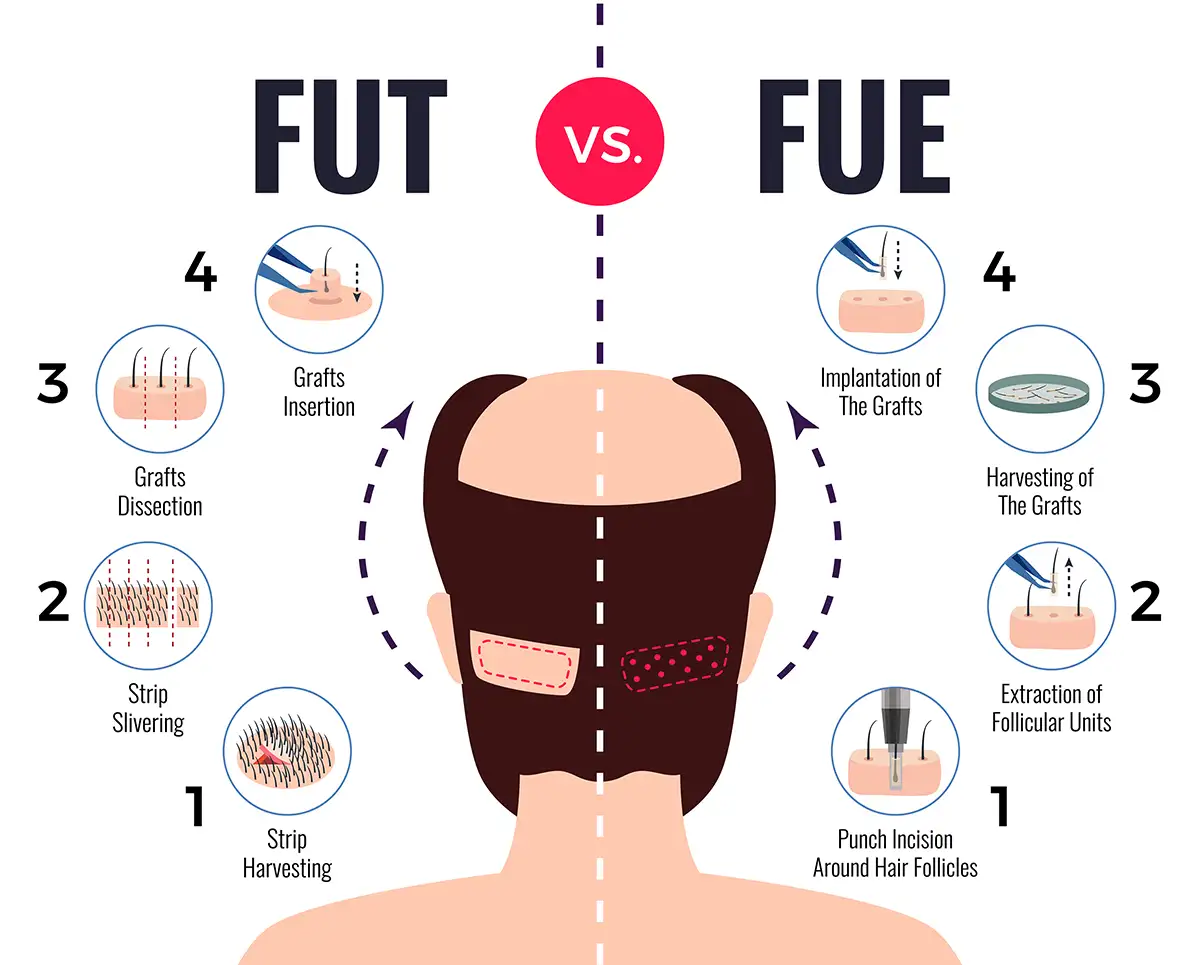 understand the Difference between FUT and FUE hair transplant