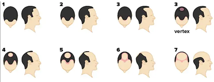 Check out different stages of male pattern hair loss
