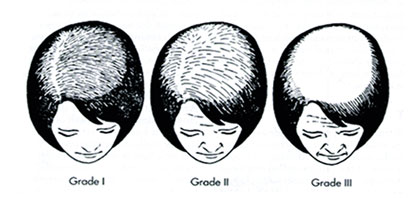  Hair Transplant Treatment for Women