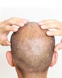  Dr. Sumit Agrawal: hair transplant expert