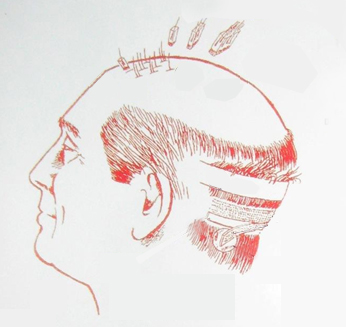  Follicular Unit Transplantation