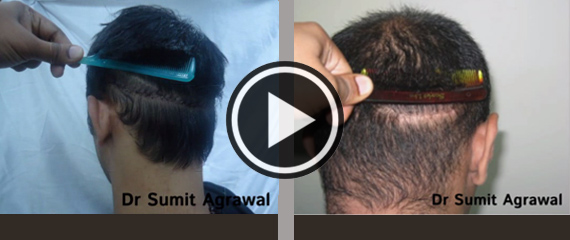  FUT Hair Transplant in Mumbai