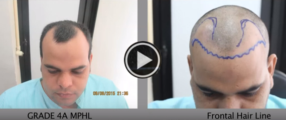  Follicular Unit Extraction (FUE) Procedure Video