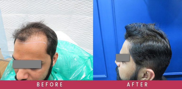  View Revision Hair Transplant Before and After photos of successful results by Dr. Sumit Agrawal.