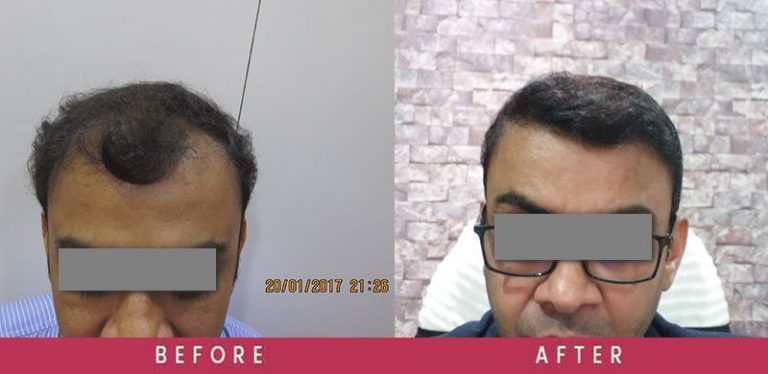  View Revision Hair Transplant Before and After photos of successful results by Dr. Sumit Agrawal