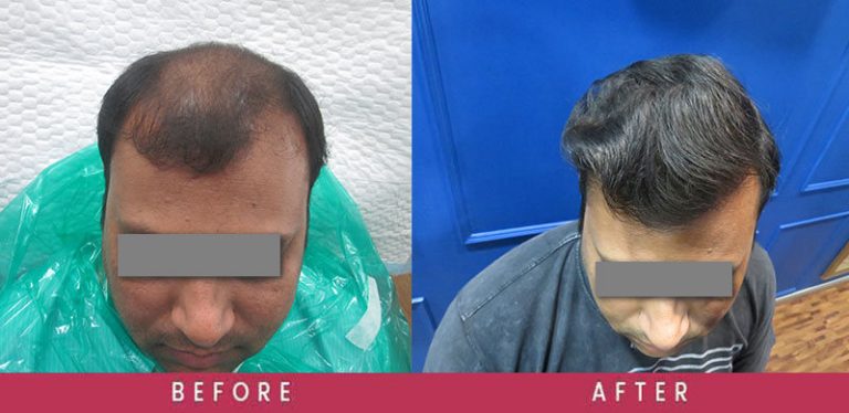  View High-Density Hair Transplant Before and After photos of successful results by Dr. Sumit Agrawal.