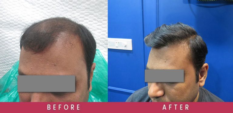  View High-Density Hair Transplant Before and After photos of successful results by Dr. Sumit Agrawal.